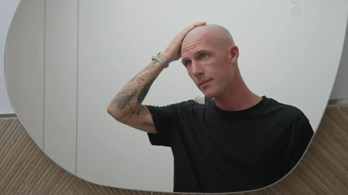 Influencer has circular hair loss – but therapy gives him hope!